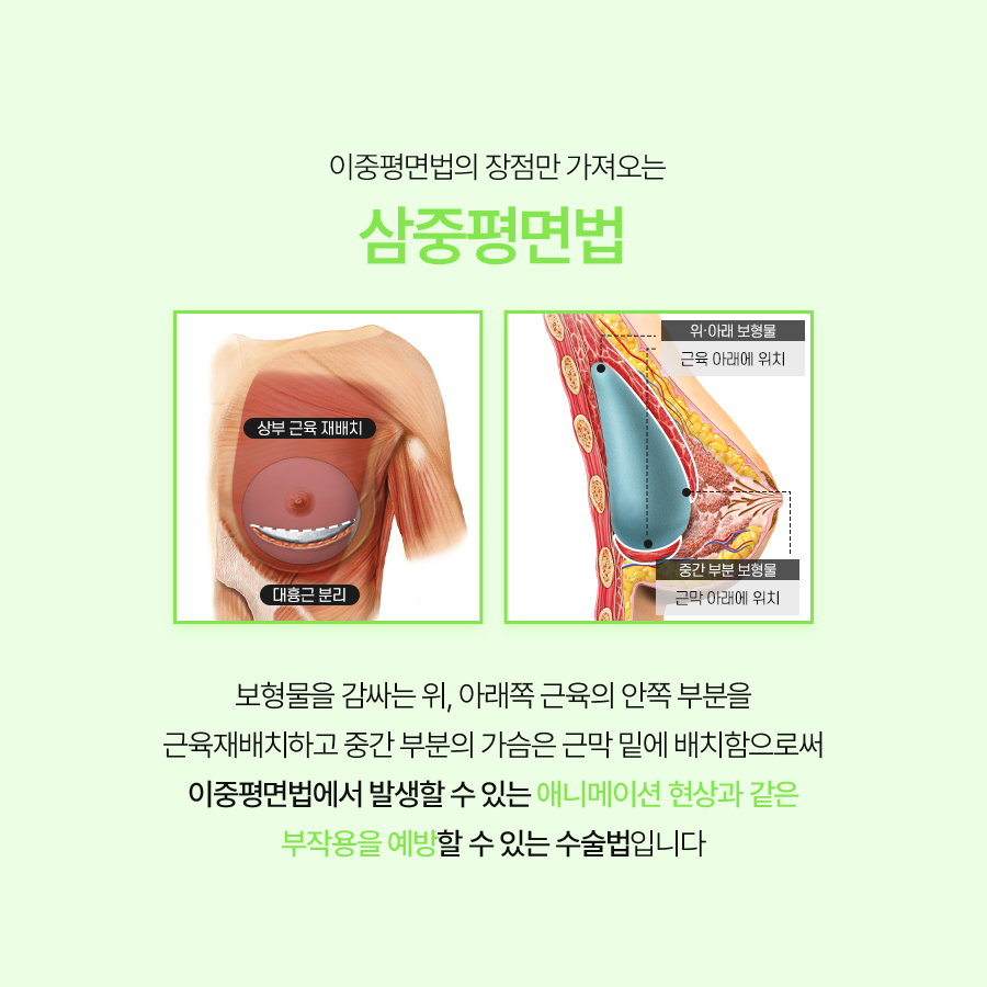 Breast Revision Surgery Timing: Why Is Everyone Looking for the Triple-Plane Technique? image 4