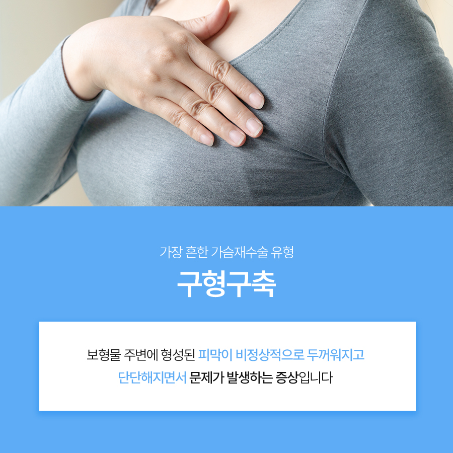 구형구축가슴재수술, 필요한 경우와 수술 방법은? 관련 이미지 3