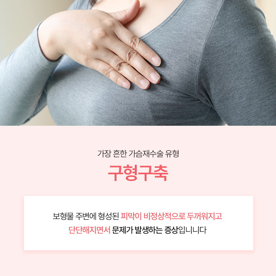 가슴구형구축 원인 알아야 재수술도 안전하다 관련 이미지 3