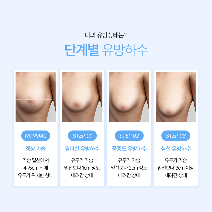 중년처진가슴성형 처짐 단계별 최적 솔루션 관련 이미지 4
