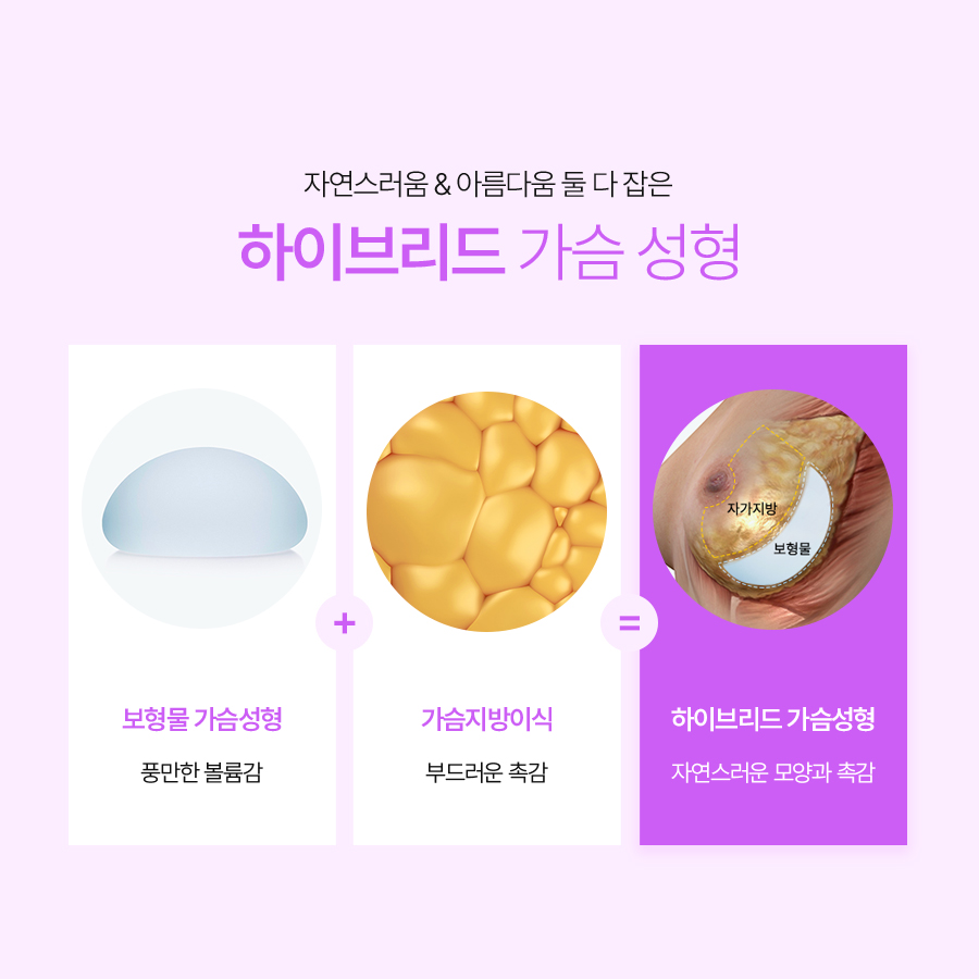 Hybrid Breast Augmentation Method: Volume and Shape at the Same Time image 4