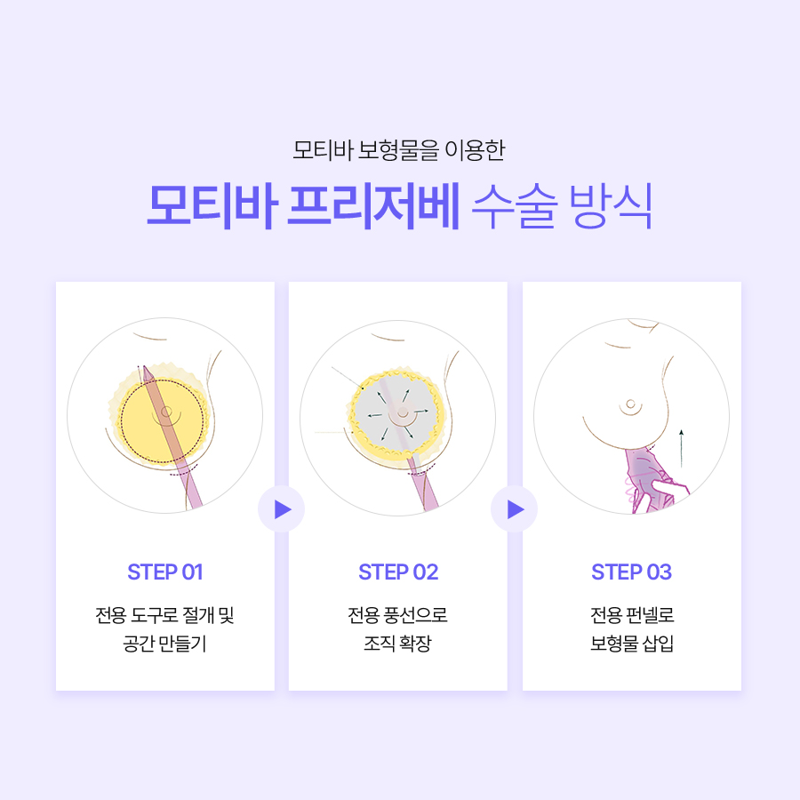 가슴확대수술방법, 모티바 프리저베의 수술방식 관련 이미지 4