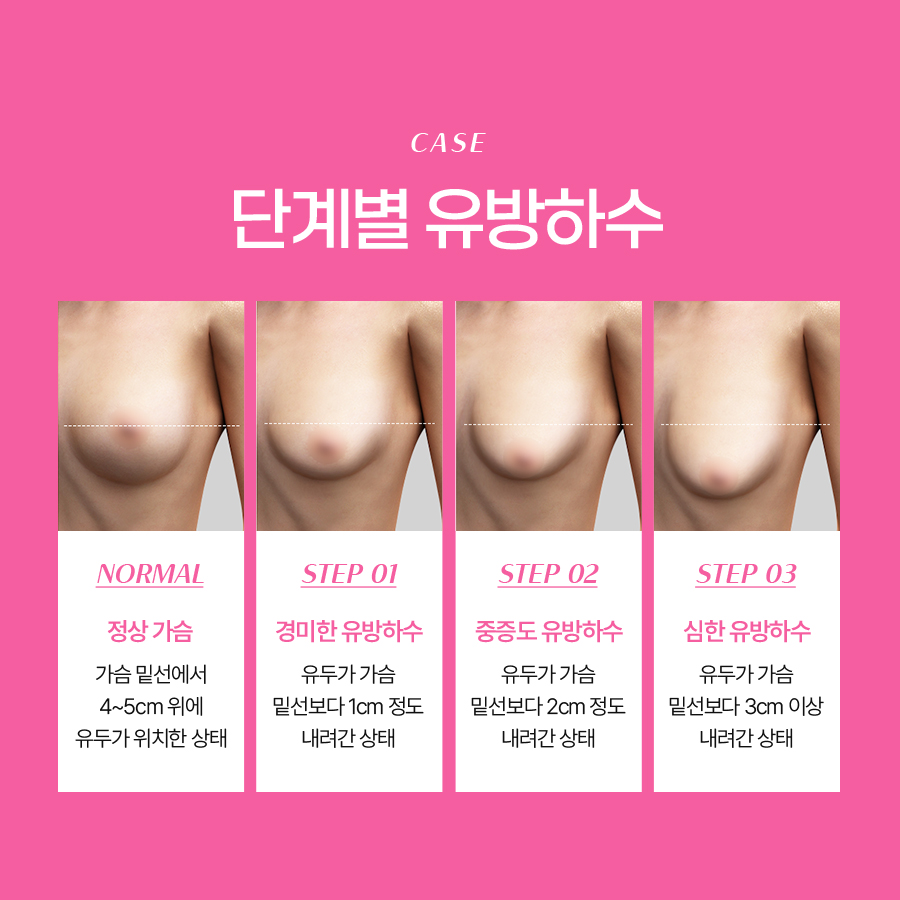 처진가슴수술비용 처짐 정도에 따라 달라지는 교정 방법 관련 이미지 4