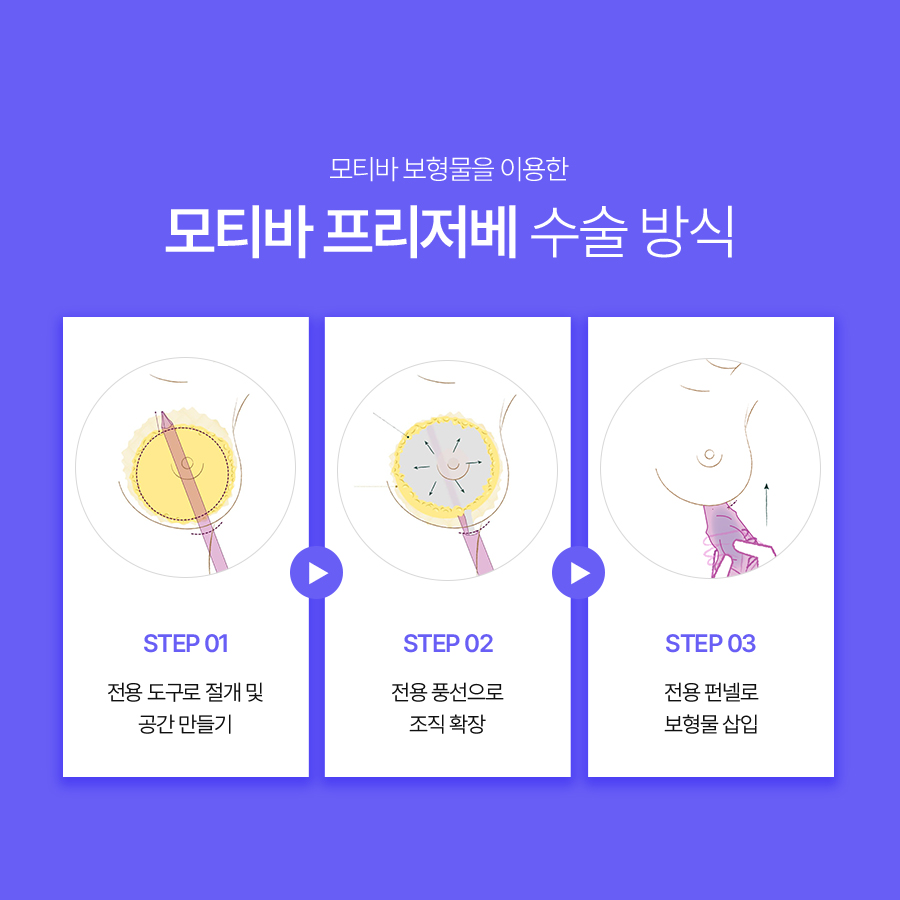가슴확대수술방법, 조직 손상을 줄이면서 볼륨을 키울 수 있을까? 관련 이미지 4