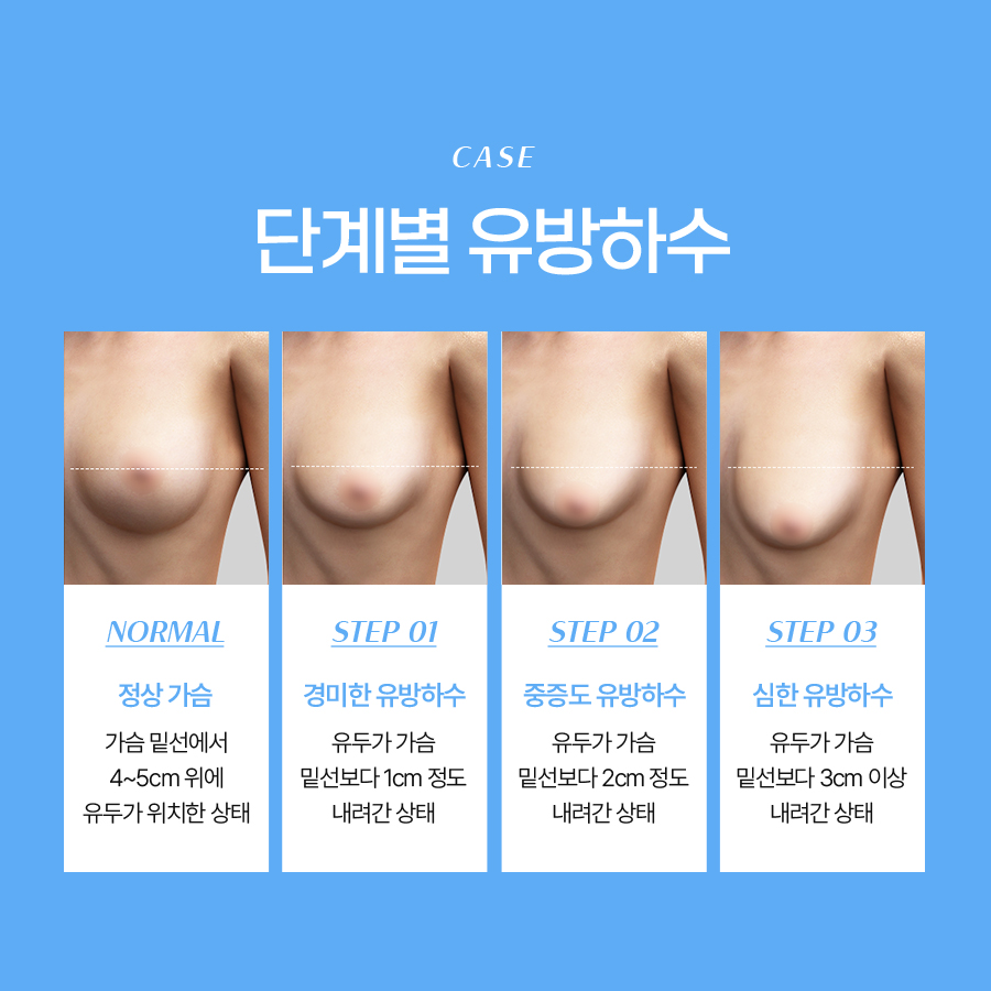 처진가슴축소술 유방하수 개선의 핵심은? 관련 이미지 4
