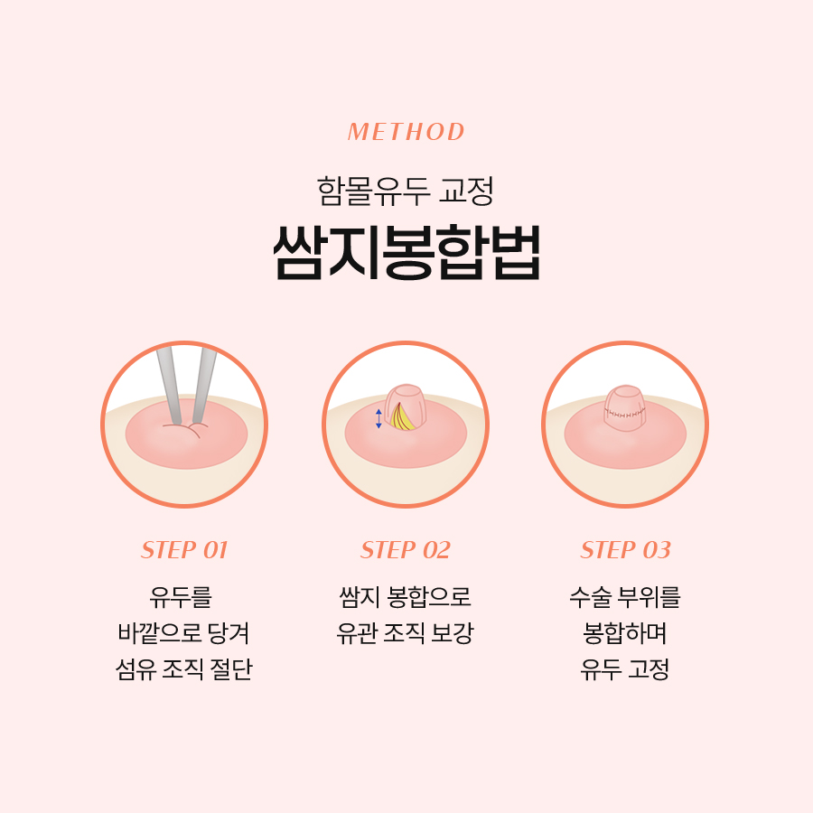 함몰유두 교정법, 어떤 수술이 나에게 맞을까? 관련 이미지 6