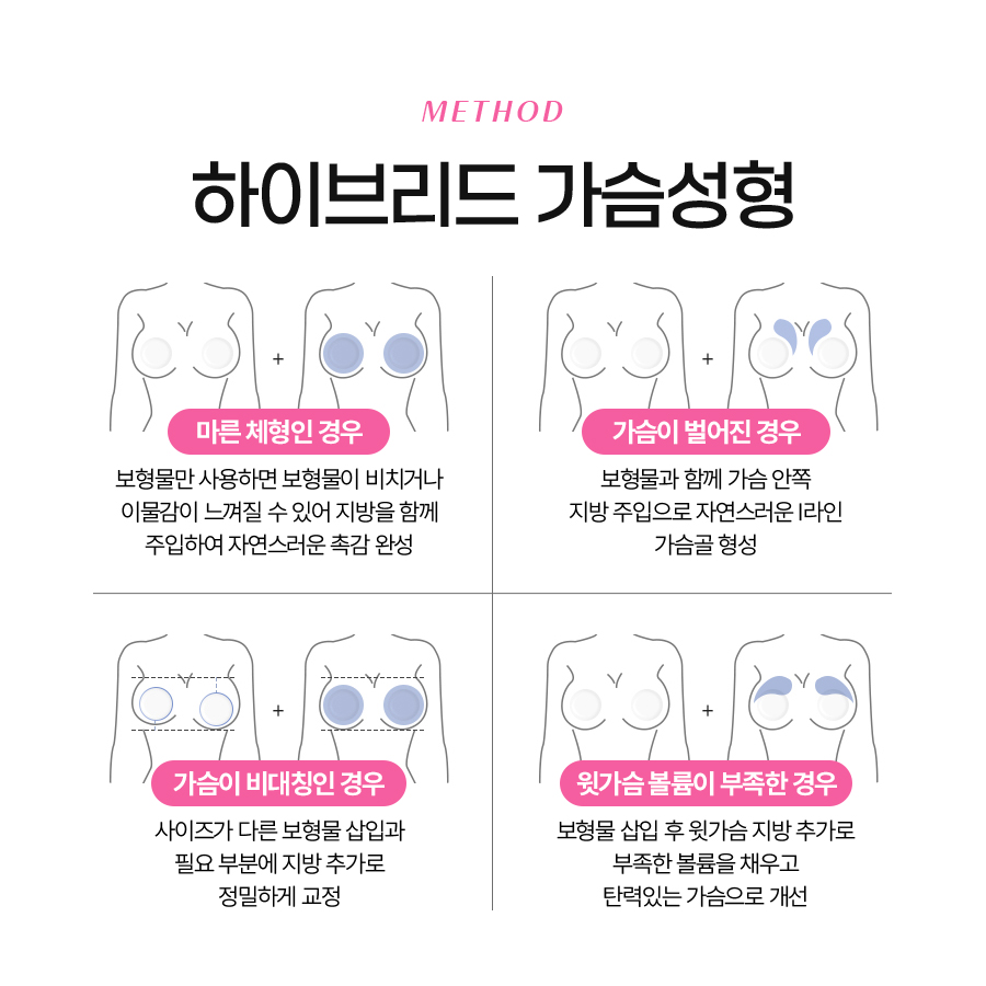 지방이식가슴성형 자연스러움을 선택하다 관련 이미지 3