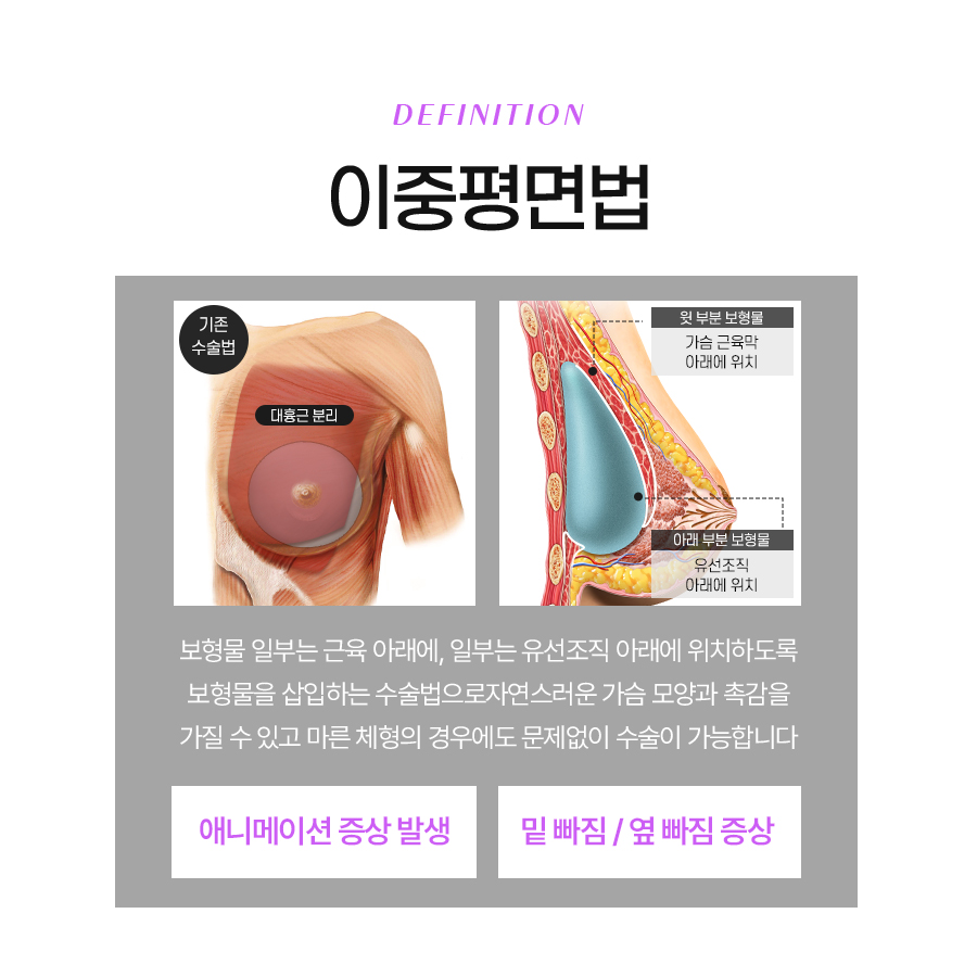 가슴성형잘하는병원 평면별 수술 접근 방식 관련 이미지 3