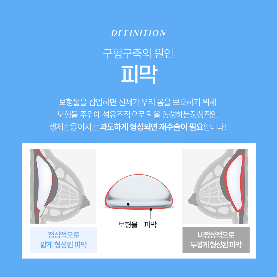 가슴구형구축원인 알고 나에게 맞는 재수술 준비하기 관련 이미지 5