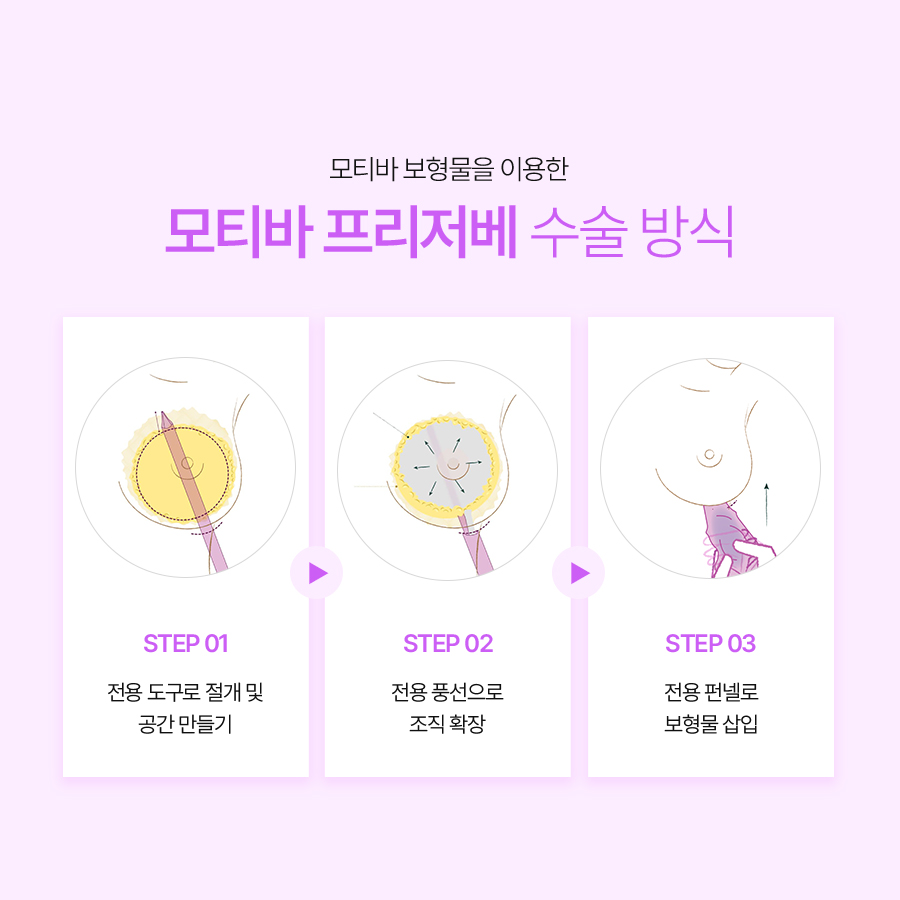 모티바 프리저베 병원추천, 수술 방식부터 장점까지 관련 이미지 4