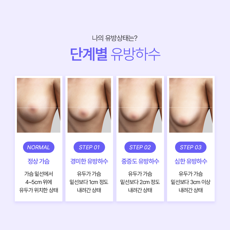 처진가슴보형물수술 체형 균형을 고려한 방법 관련 이미지 4