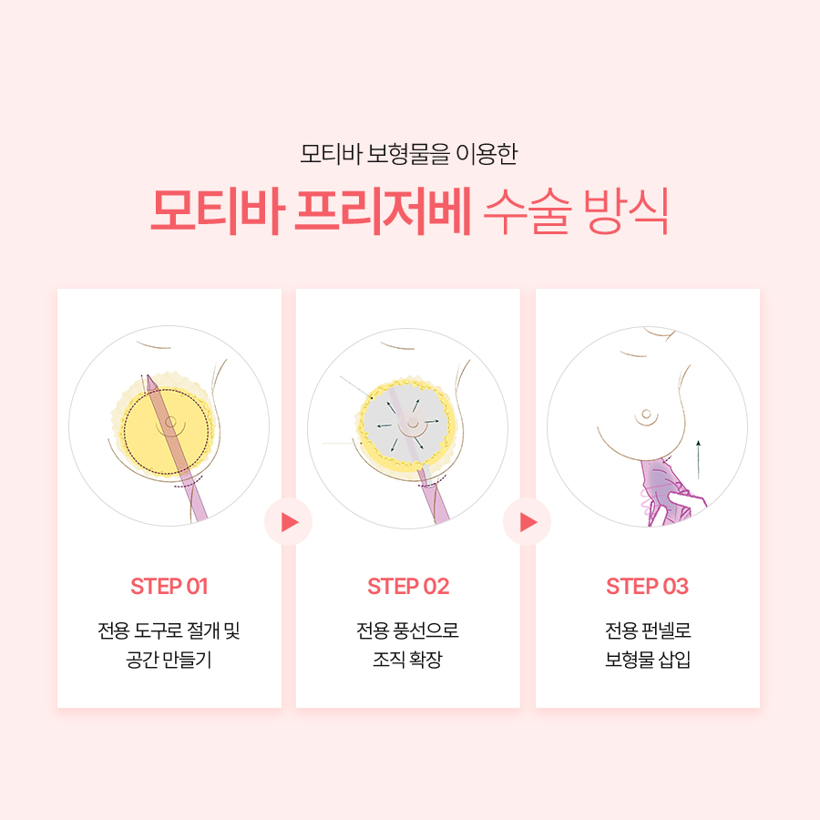 가슴수술병원후기, 모티바 프리저베의 수술 방식과 특징 관련 이미지 4
