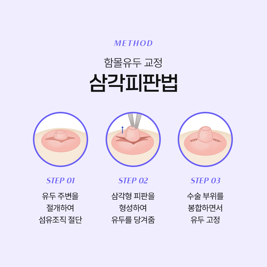 함몰유두교정술 적합한 수술방법은? 관련 이미지 4