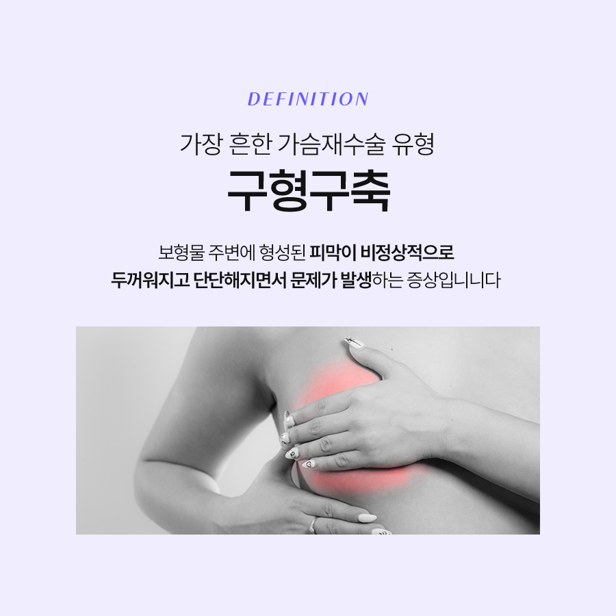 가슴재수술 구형구축 원인 파악을 확실하게 관련 이미지 3