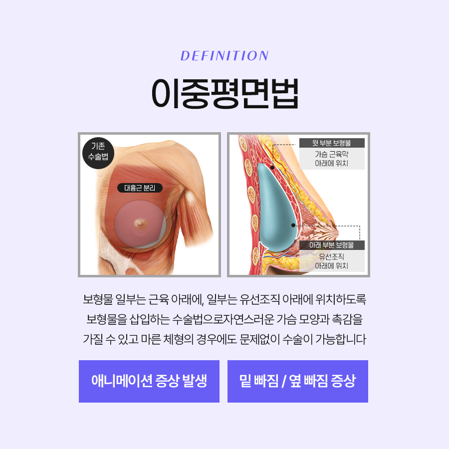 가슴확대수술방법 종류별 특징은? 관련 이미지 5