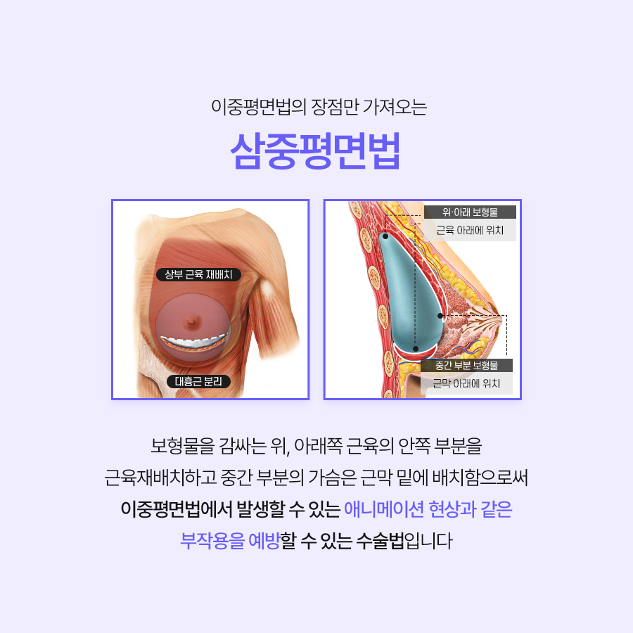 가슴수술잘하는병원 자연스러운 움직임을 고려한 가슴수술 방식 비교 관련 이미지 4
