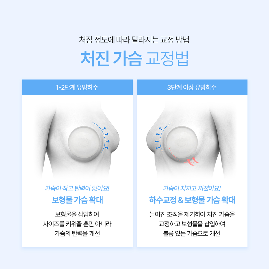 중년처진가슴성형 처짐 단계별 최적 솔루션 관련 이미지 5