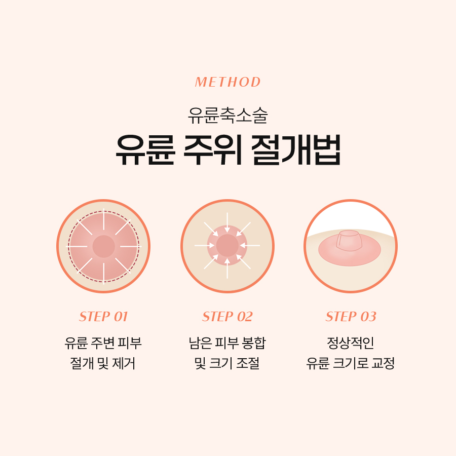 유륜 크기 교정 수술 방법, 어떤 방식이 내게 맞을까? 관련 이미지 5
