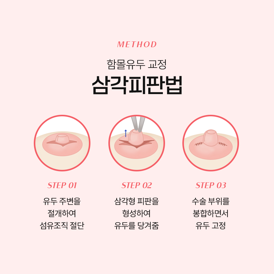 함몰유두교정방법 기능과 미용을 동시에 개선하는 솔루션 관련 이미지 4