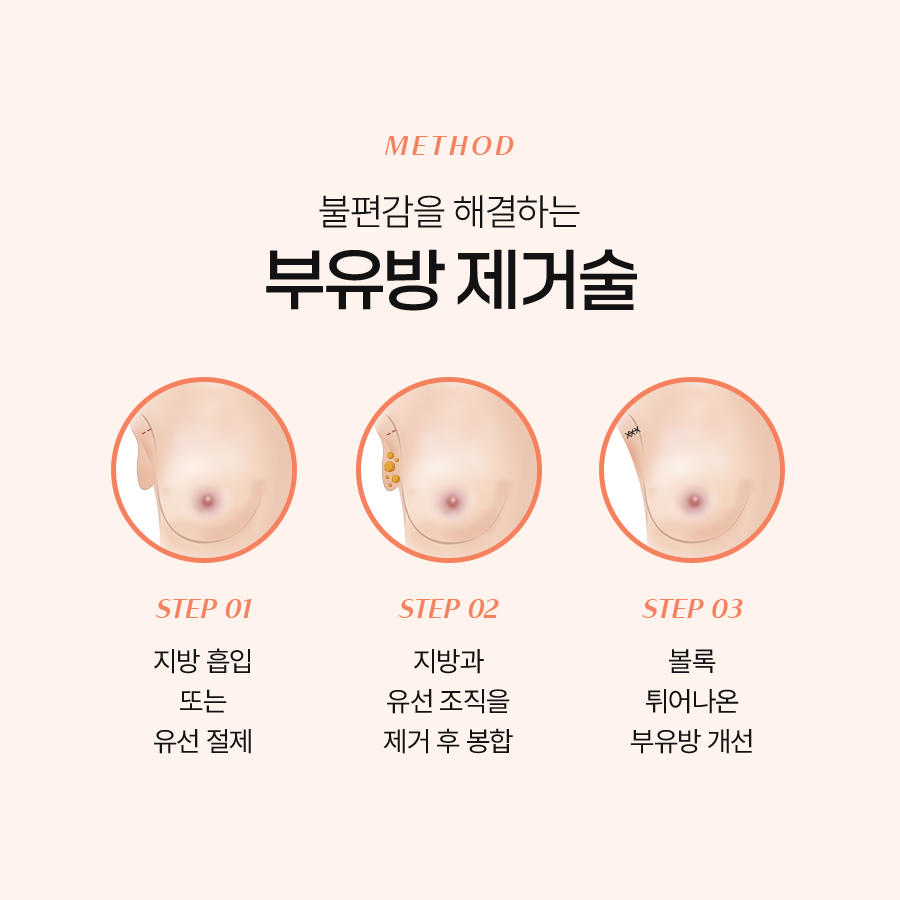 부유방교정 아름다운 몸매를 위한 첫걸음 관련 이미지 5