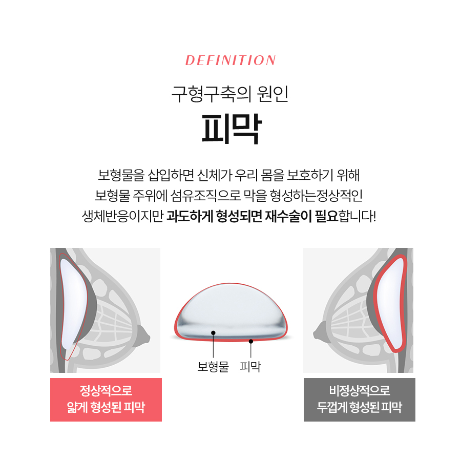 가슴구형구축수술 언제 필요하고 어떻게 진행될까? 관련 이미지 5