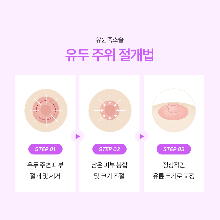 유두교정술병원 입체적인 가슴의 완성은 유륜축소부터 관련 이미지 4