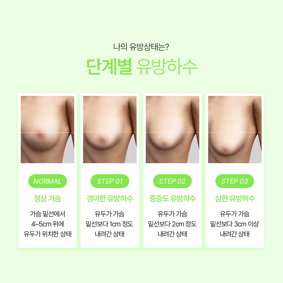 유방하수교정수술, 처짐 고민 해결하고 볼륨 중심 이동 관련 이미지 4