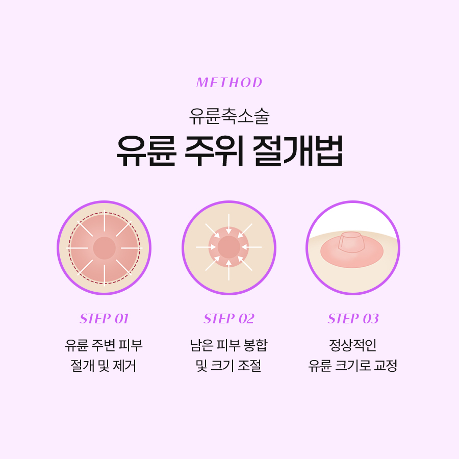What Is the Areola Reduction Surgery Method, and How Is It Performed? image 5