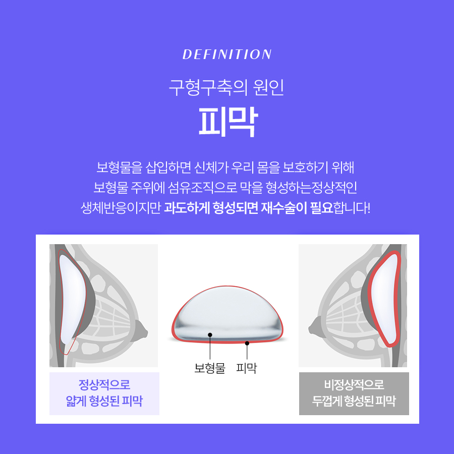 겨드랑이절개 가슴성형 다시 완성하는 아름다운 라인 관련 이미지 4