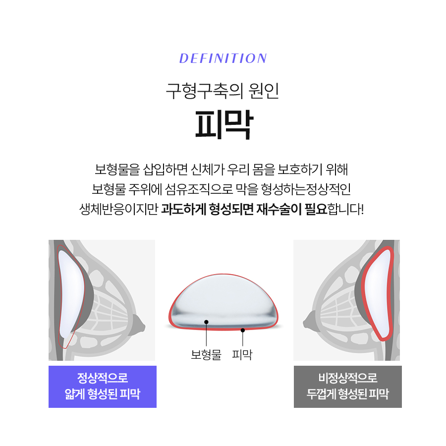 구형구축피막제거 가슴 재수술 성공하기 위한 조건 관련 이미지 5