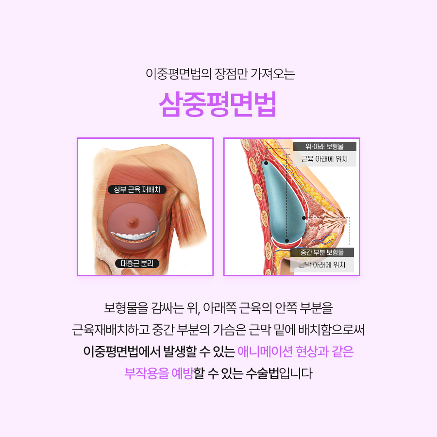 가슴재수술방법, 삼중평면법의 특징과 절개법 확인 관련 이미지 4