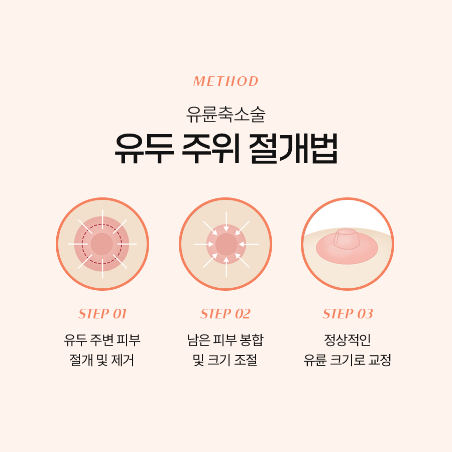 유륜 크기 교정 수술 방법, 어떤 방식이 내게 맞을까? 관련 이미지 4