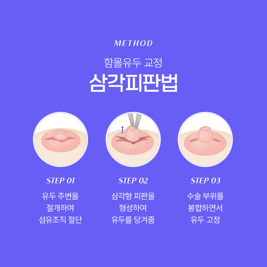 함몰유두성형 기능적인 이유로도 고려해야 하는 이유 관련 이미지 4