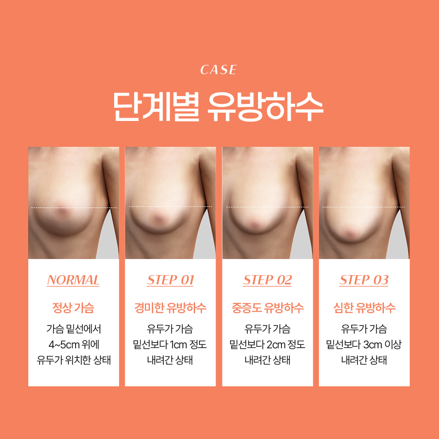 Before Considering Breast Lift Surgery, Why Does Breast Ptosis Occur? image 4