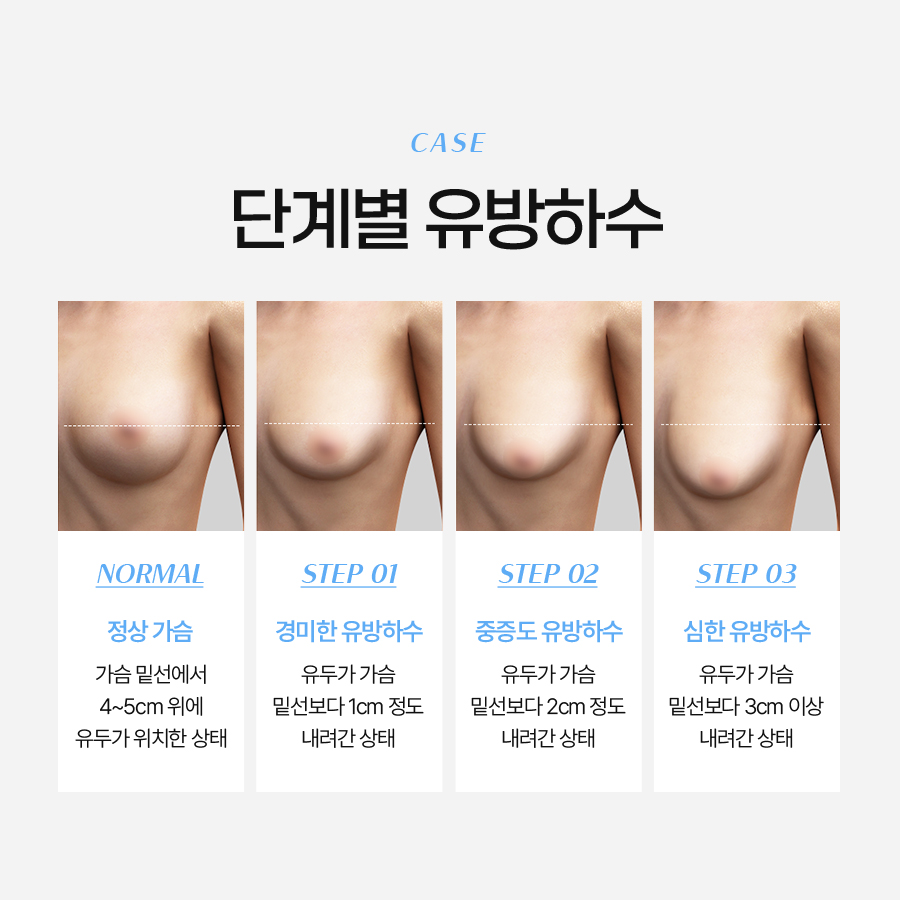 유방하수교정수술 자연스러움과 탄력을 되찾는 길 관련 이미지 4
