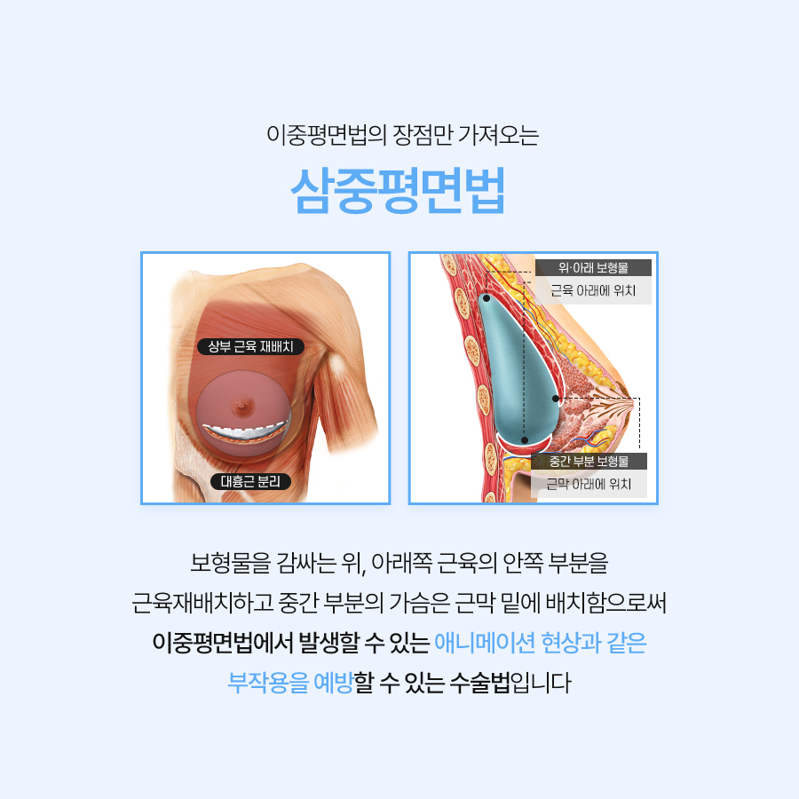 Three-Plane Breast Augmentation: Natural-Looking Breasts Begin with Planning image 4