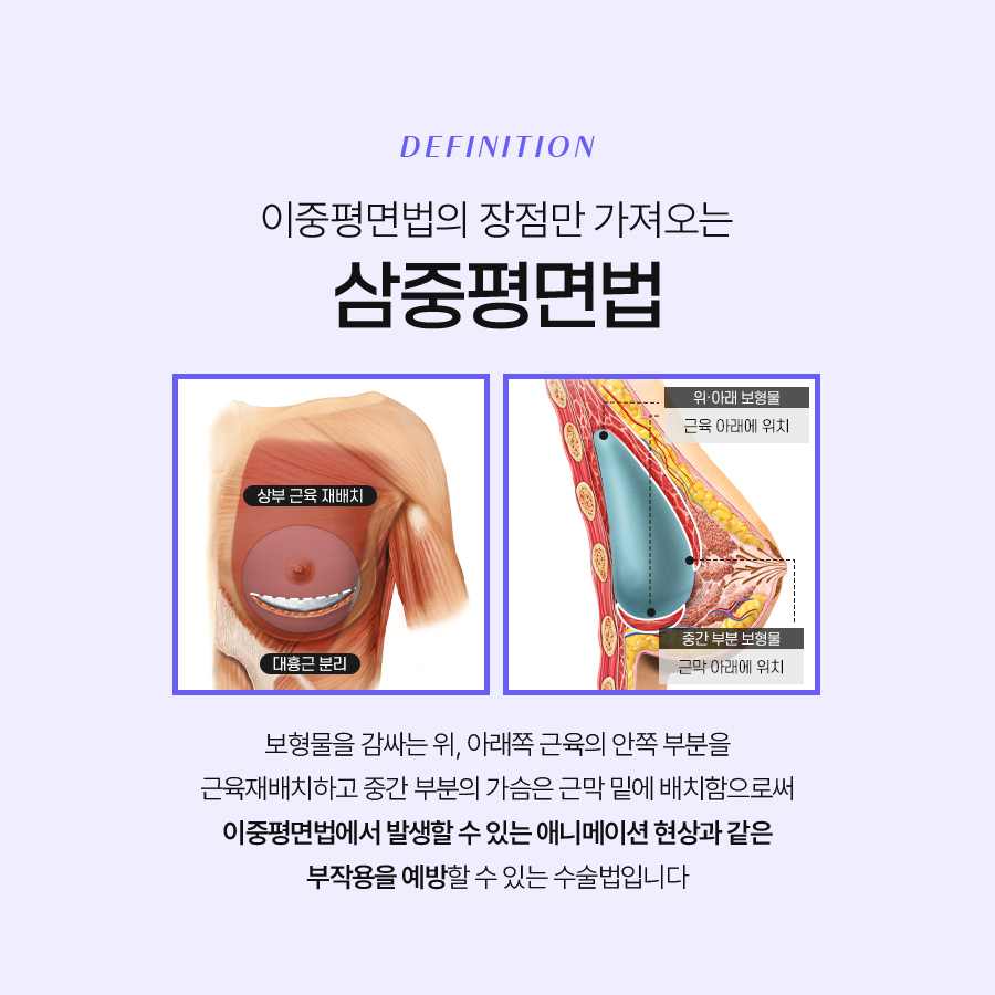 가슴확대수술 만족스러운 결과를 위해서는 관련 이미지 6
