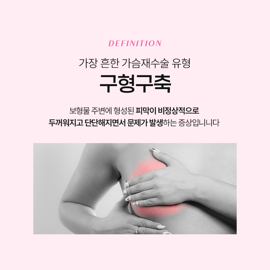 가슴구형구축 원인 정확히 파악해야 관련 이미지 3