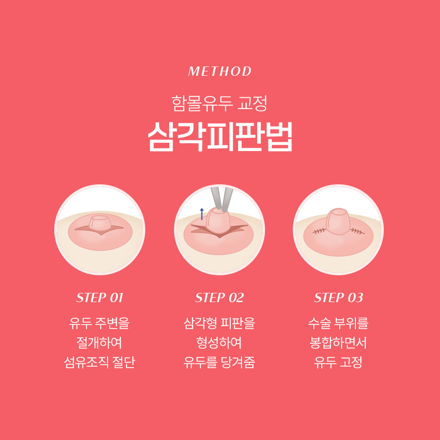 함몰유두교정수술 만족도 높은 이유 관련 이미지 4