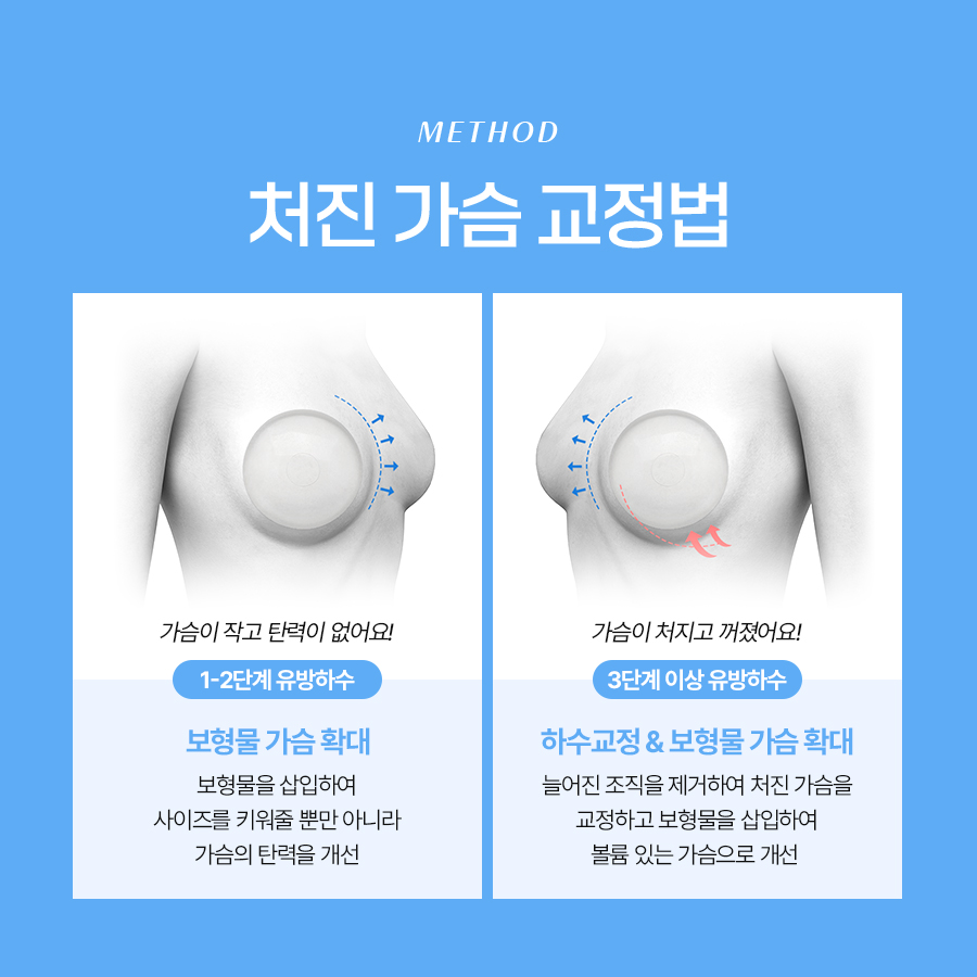 처진가슴축소술 유방하수 개선의 핵심은? 관련 이미지 5
