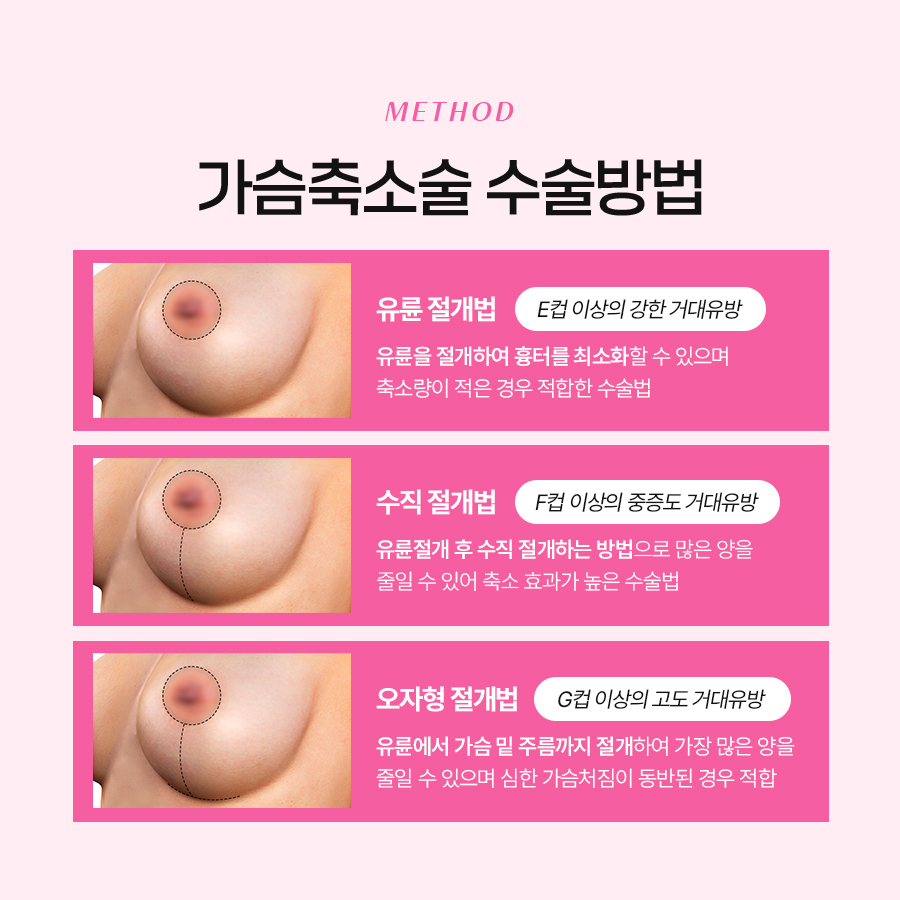 가슴거대유방증 해결, 가슴축소수술로 가능한 이유 관련 이미지 5
