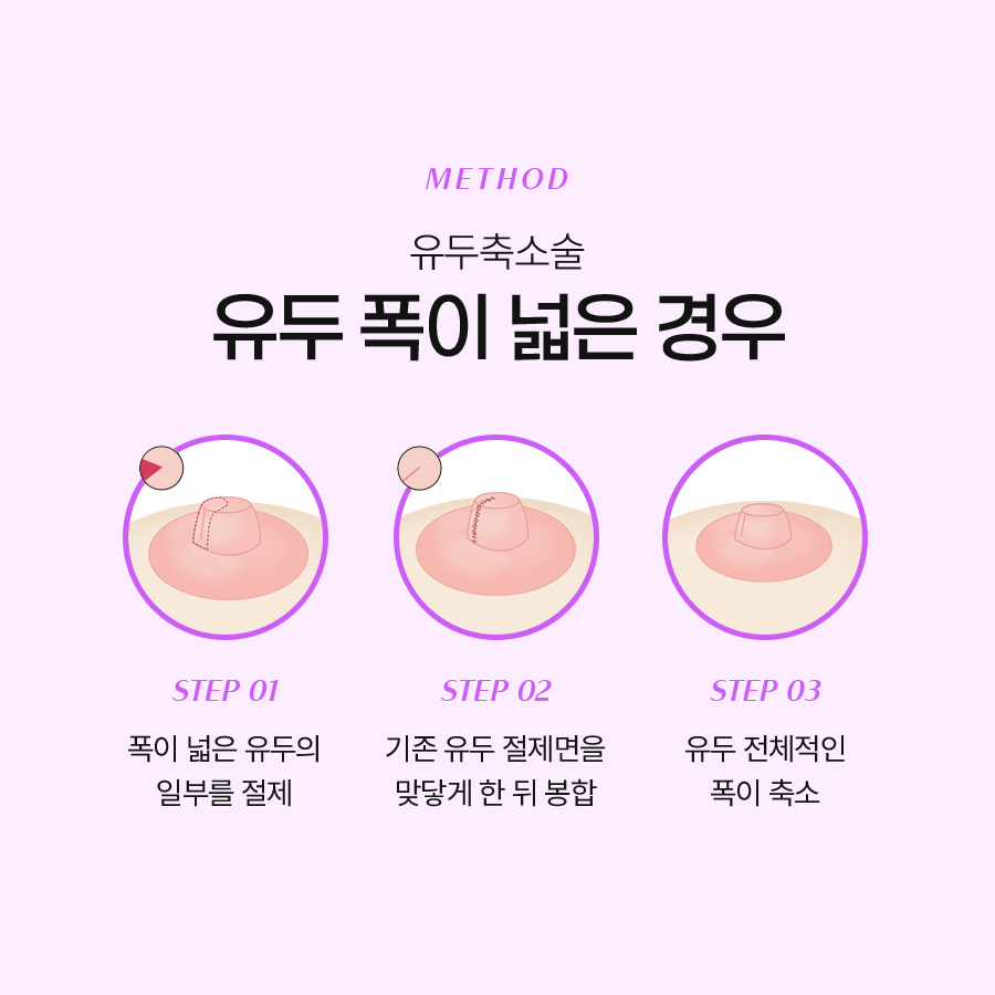 유두교정수술병원 티 나지 않는 자연스러운 유두축소술 관련 이미지 4
