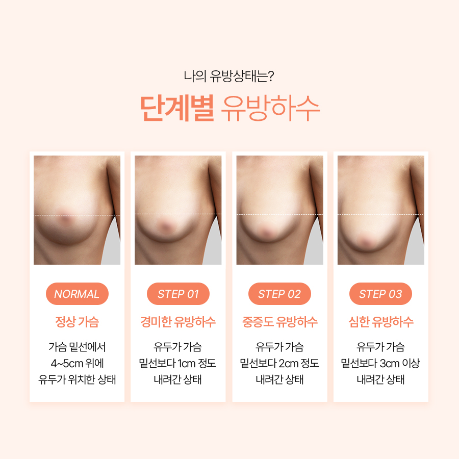 가슴처짐 교정수술 탄력과 라인 개선의 핵심 관련 이미지 4