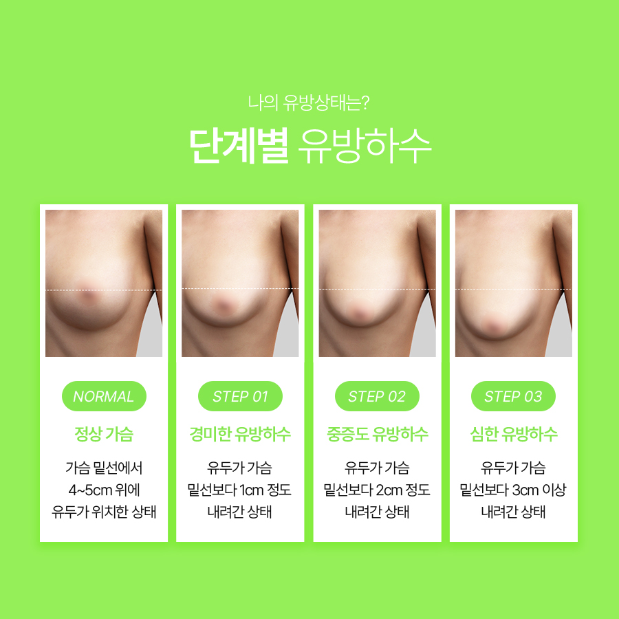 Breast Ptosis Correction Surgery: Why You Should First Examine the Causes of Sagging Breasts image 4