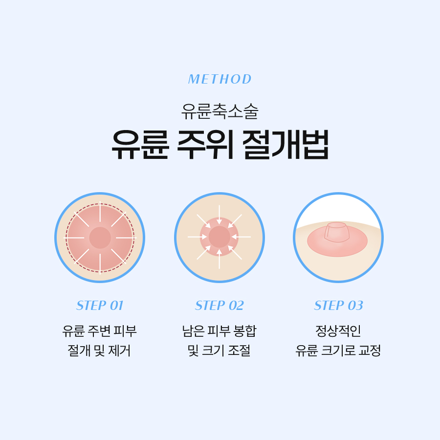 가슴유륜축소수술 꼭 알아야 할 모든 것 관련 이미지 5