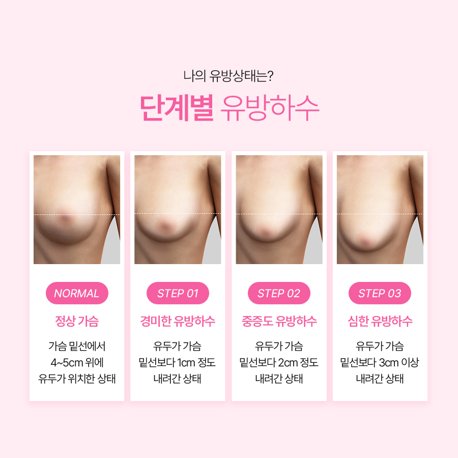 처진가슴교정술 가슴 탄력 개선을 위한 방법 관련 이미지 4