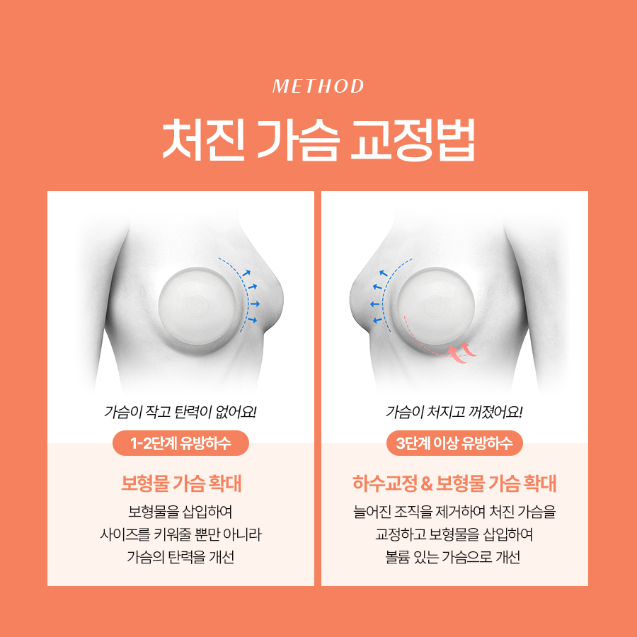 Before Considering Breast Lift Surgery, Why Does Breast Ptosis Occur? image 5