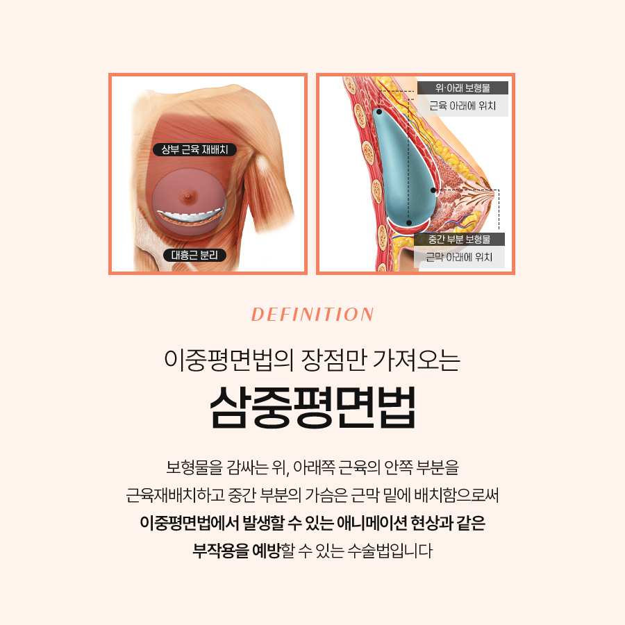 가슴성형수술병원 추천 나에게 맞는 가슴성형 선택법 관련 이미지 5