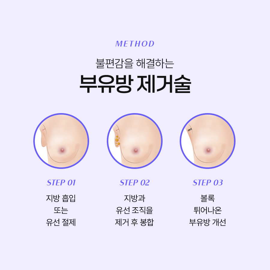 Removing Auxiliary Breast Fat to Achieve a Smooth Upper Body Line image 5