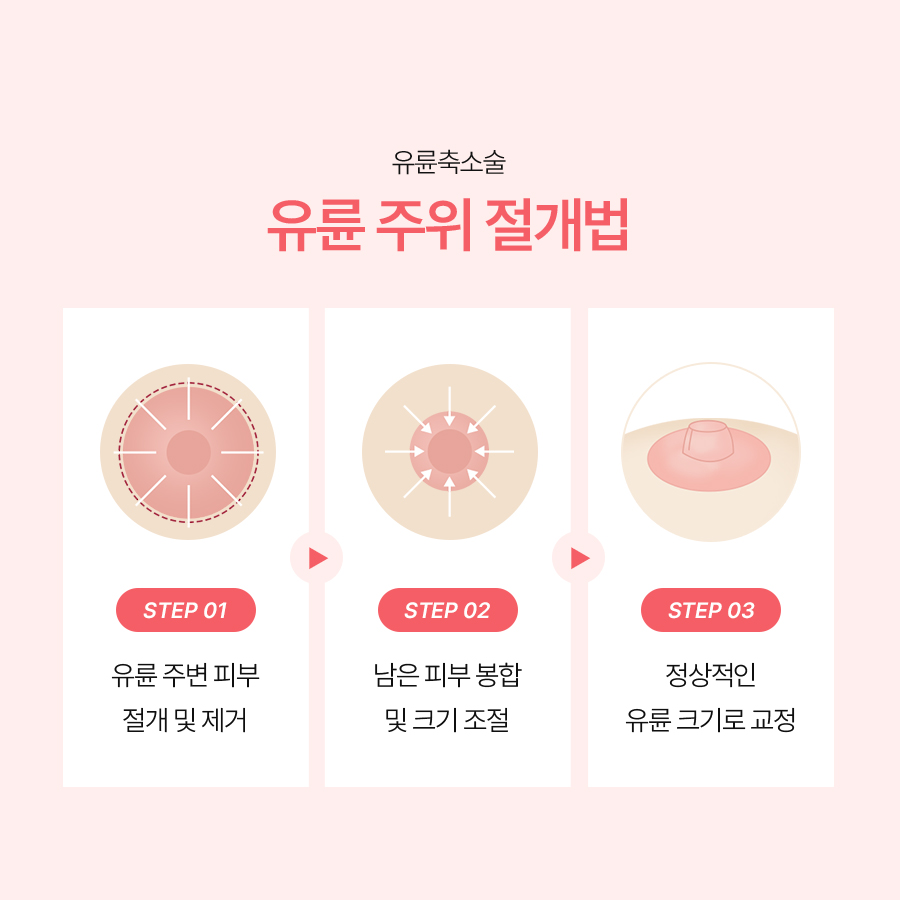 유륜크기교정 유관 보존과 감각 유지의 중요성 관련 이미지 5